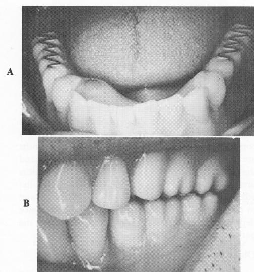 2 Metal occlusal posterior teeth have metal rails inside acrylic teeth