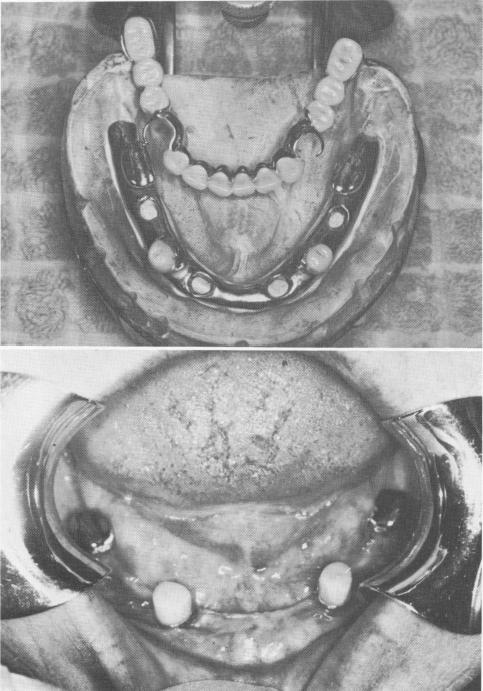 1 Vitallium template cast from revised mandibular stone model