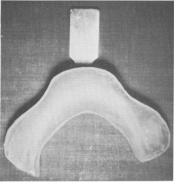 1 Acrylic tray reduced in size to assimilate underlying jaw bone shape
