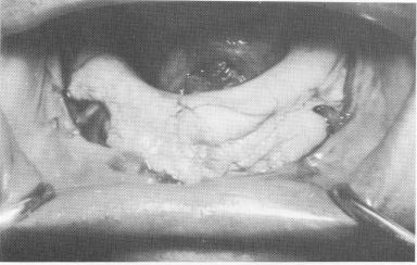 2 Cold cure acrylic tray molded directly to exposed jaw bone 