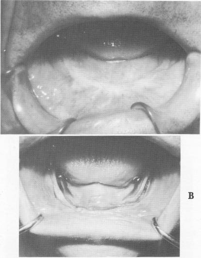 4 Resorbed edentulous mandible prior to first surgical stage incision