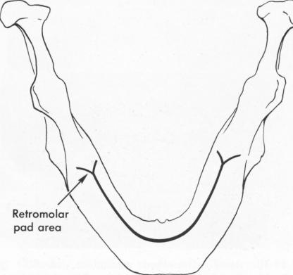 1 V shaped incision directly in front of mandibular retromolar pad areas