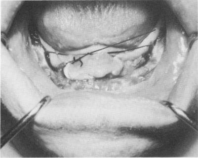 2 Lingual tissue sutured from one side to other in criss cross fashion