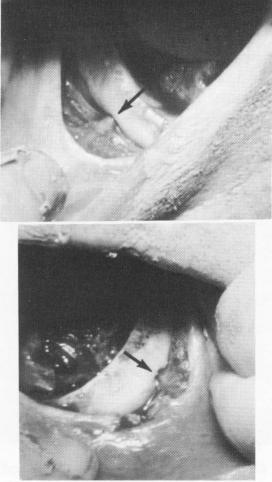 3 Neurovascular bundle exiting mental foramina exposed before impression
