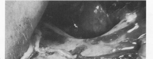 1 Resorbed mandible with mental foramen dehiscent at the residual crest