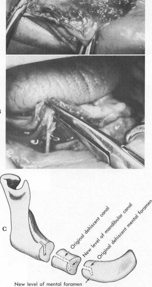 2 Resorption of mandible left entire mandibular canal dehiscent