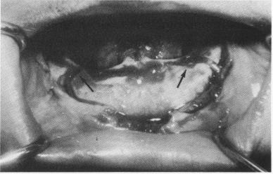 3 Dehiscent mandibular canal or mental foramen can be lowered 