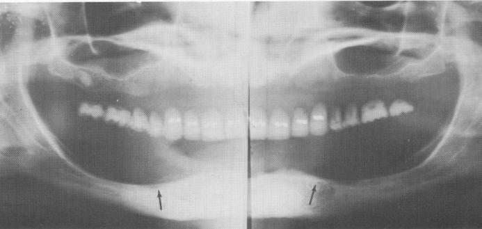 1 Panorex x-rays showing unilateral dehiscency of mental foramina