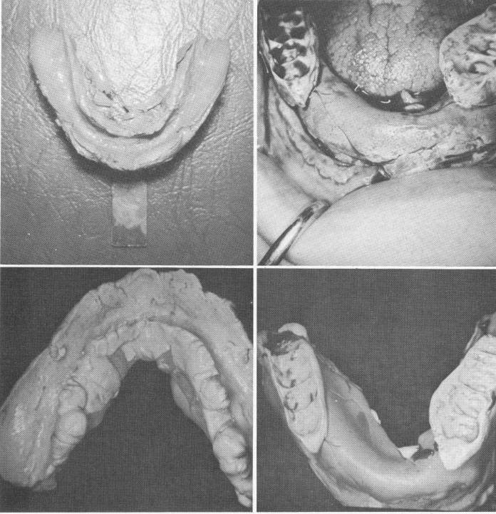 1 Rubber impression of exposed mandibular bone including many landmarks