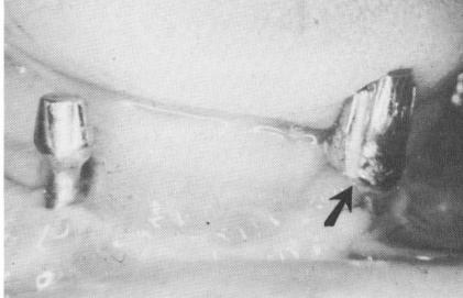 1 Extended gold coping cemented on poorly designed dental implant post