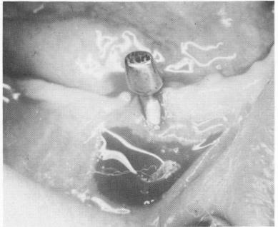 2 Tissue sometimes recedes around excessively long neck of dental implant
