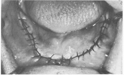 1 Continuous suturing around arch from retromolar pad to retromolar pad