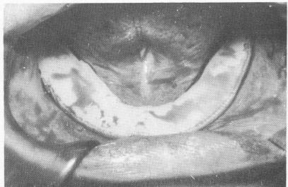 2 Intraoral bandage used directly over the sutured tissue