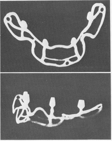 1 Subperiosteal implants radiographed with special x rays to know flaws