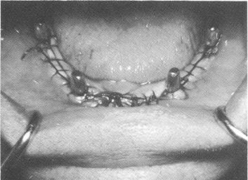 3 Suturing adequately closed tissue wound & adapt tissue to dental posts