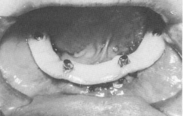 4 Intraoral bandage festooned & placed on protruding posts & on sutures