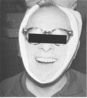 1 Ice packs inside towel in neck & chin area & tied around top of head