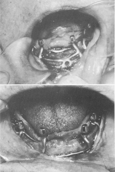 2 Incision & reflection of mucoperiosteal tissue  to expose jaw bone