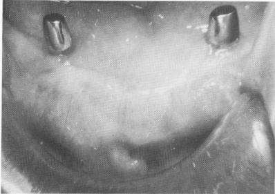1 Tissue around dental implant posts 12 years postoperatively