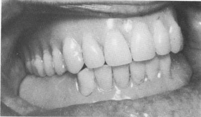 2 Temporary acrylic stent obtained from surgical jaw bone bite prepared