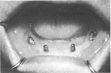1 Soft tissue healing covering dental implant completed in 3 to 6 weeks 