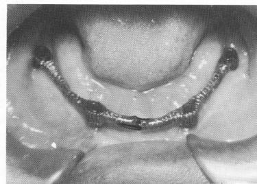 2 Mandibular superstructure framework placed on protruding implant posts