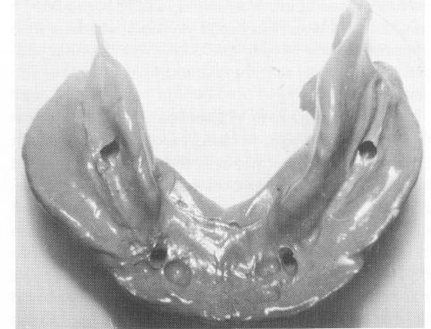 4 Mandibular superstructure framework picked up with elastic impression