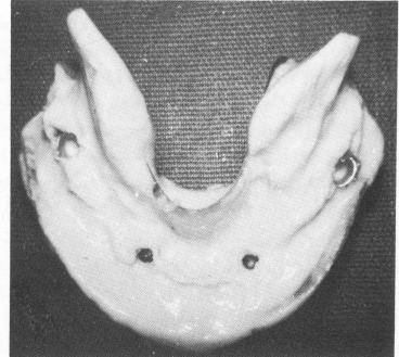 5 Alginate impression used to pick up mandibular superstructure