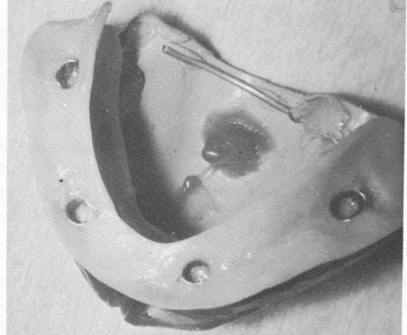 1 Mandibular subperiosteal implant fabricated to metal superstructure