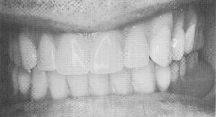 2 Completed denture in place, which is implant borne only