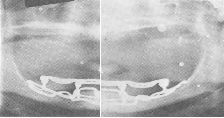 1 Close adaptation of implant denture to bone of resorbed mandible x ray