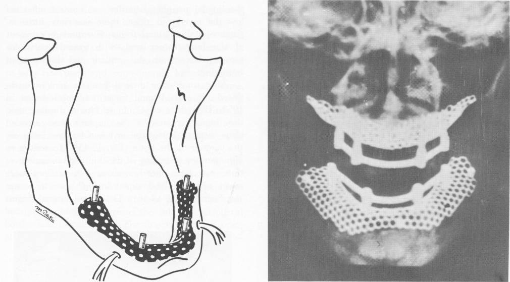 1 Marziani designed intraoral tantalum subperiosteal implant