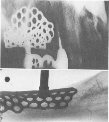 2 X ray showing maxillary and mandibular tantalum subperiosteal implants
