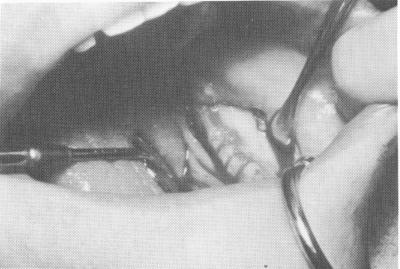 2 Basal bone exposed, showing lingual notches below mylohyoid ridge