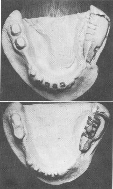 3 Master stone cast illustrating depth & angulation of lingual notches 