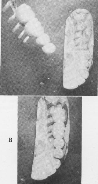 1 Temporary acrylic splint made & adjusted to fit over implants & teeth