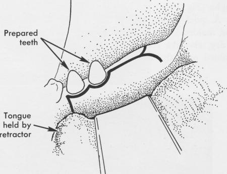 2 Temporary acrylic splint positioned over tooth & implant abutment