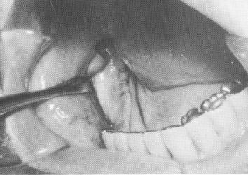 2 Elastic impression of jaw bone taken & picked with alginate impression