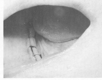3 Tissue wound in mandibular arch sutured