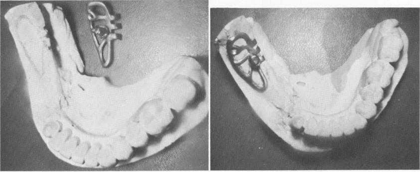 1 Subperiosteal implant and mandibular stone cast with lingual notches