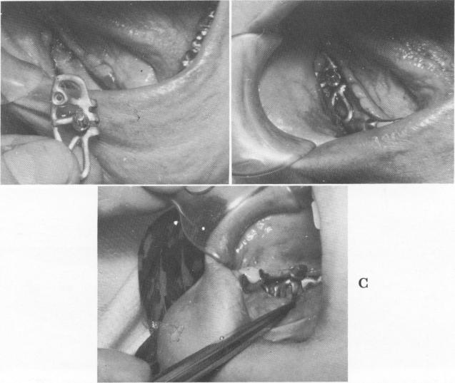 2 Subperiosteal implant fitted snugly over mandibular model