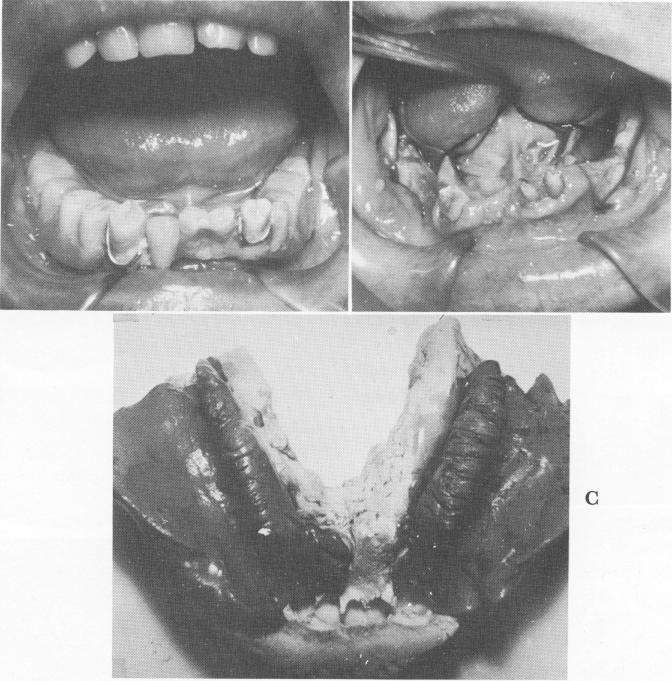 1 Three lower teeth previously prepared for full crown coverage