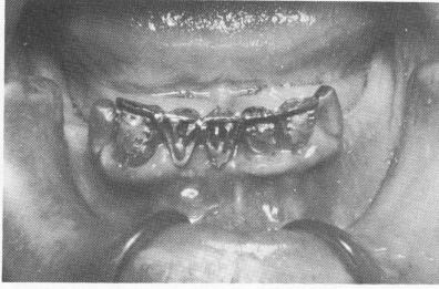 2 Bilateral rubber base dental impression picked by alginate impression