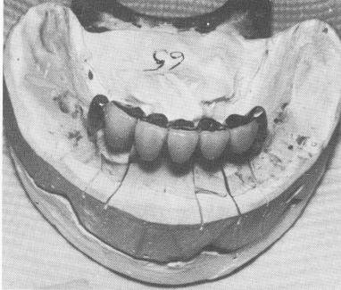 3 Castings fitted on abutment teeth with pontics soldered to framework