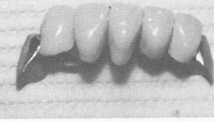 1 Cast cobalt chrome subperiosteal implants on mandibular model