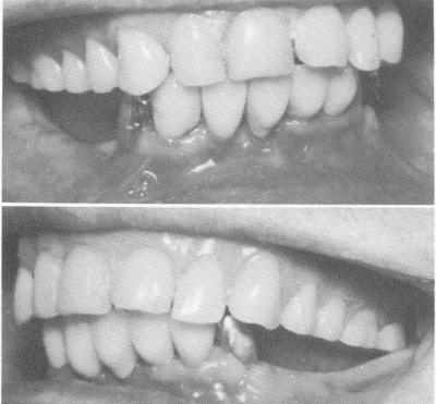 2 Subperiosteal implants fitting accurately on exposed mandibular bone