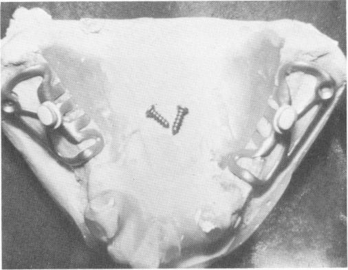 3 Closely adapted tissues close wounds & cover necks of dental implants