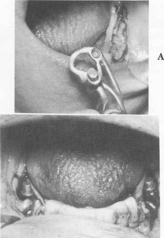 4 Temporary acrylic mandibular splint made if fixed one is not prepared