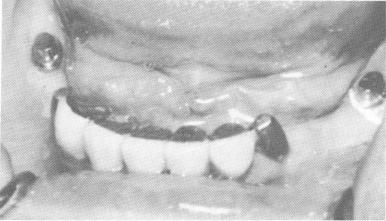 1 Healing is uneventful if good surgical & prosthetic principles followed