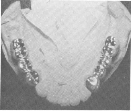 2 Fixed partial dentures from implant & anterior gold thimble impression